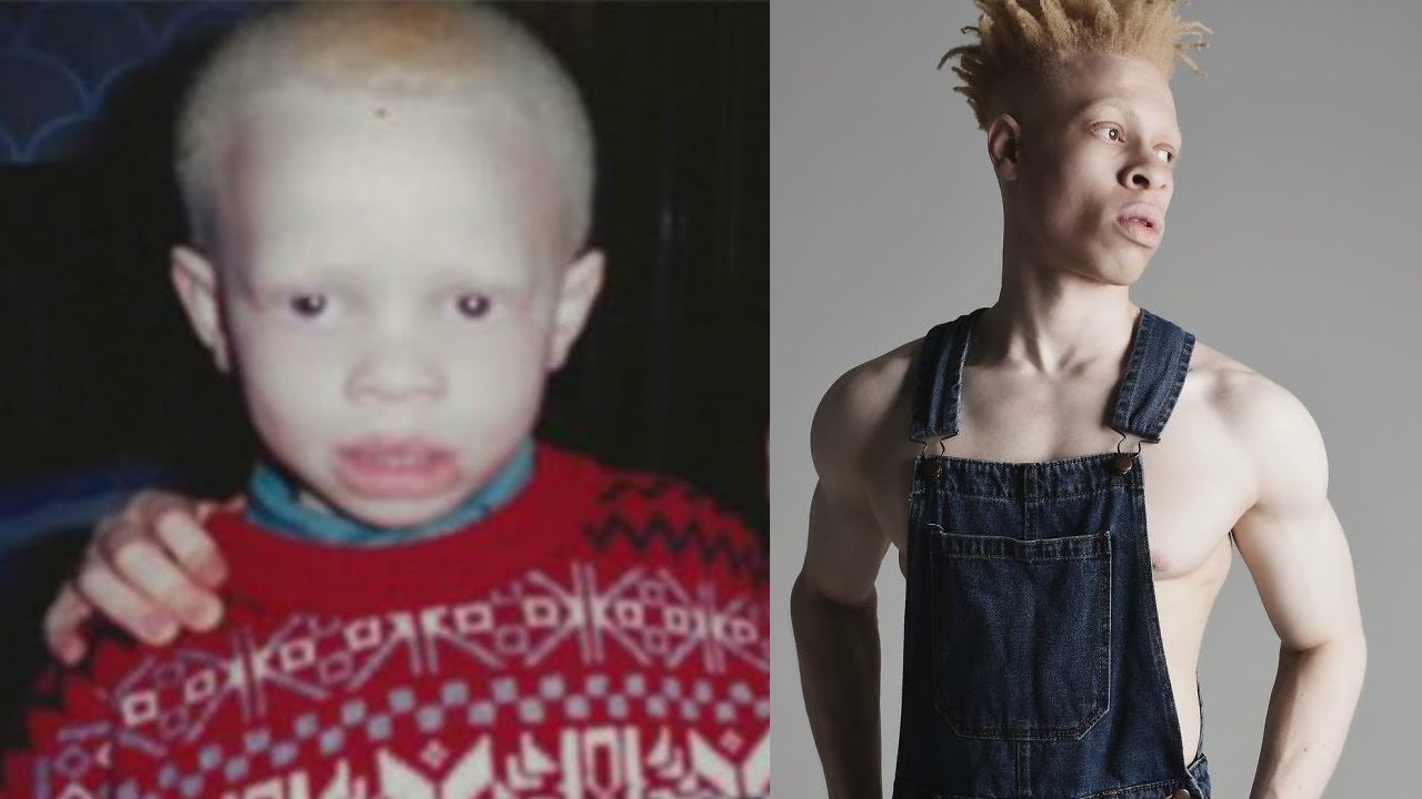 Bullied As A Kid, This Albino Guy Beats Everyone By Becoming A Model - YouTube
