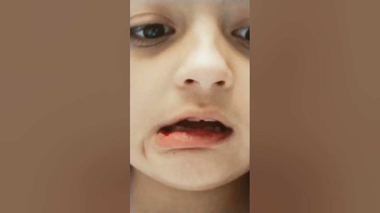 my lip bleeding YouTube