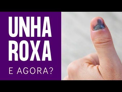 UNHA ROXA, o que devo fazer? Por Dr. Luiz Gameiro, dermatologista - YouTube