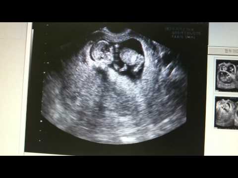 Video: Ano Ang Hitsura Ng Kambal Sa Ultrasound