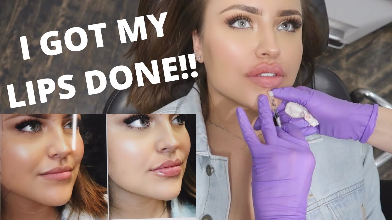 TRYING LIP FILLER FOR THE FIRST TIME! IS IT WORTH IT? VLOG YouTube