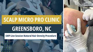 SMP Live Session Natural Hair Density Procedure | Scalp Micro Pro Clinic #scalpmicropigmentation