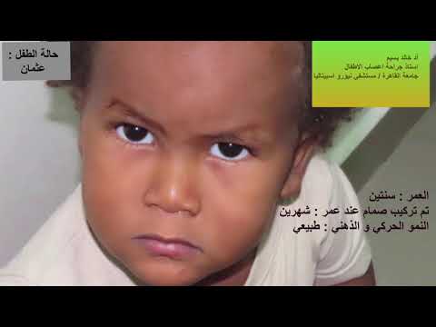 حالة ارتفاع متوسط في ضغط المخ