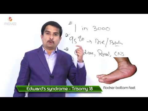Video: Kodėl trisomija 18 vadinama Edvardso sindromu?