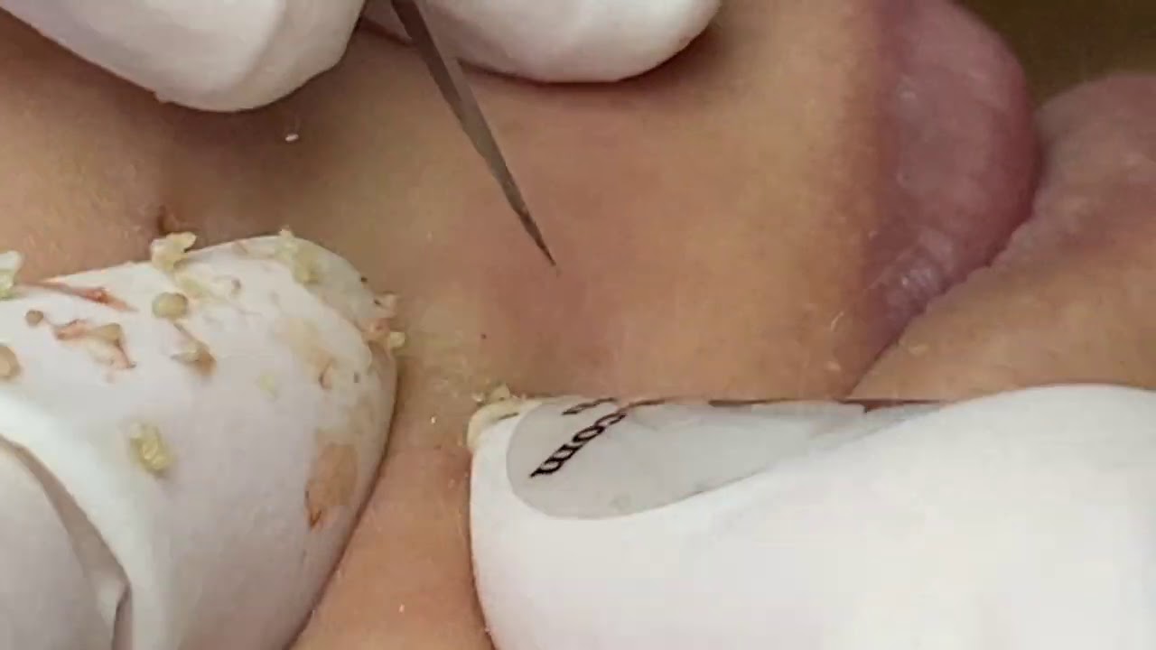 Hyperpigmentation acne | Mụn Làm Thâm Da - ThuyTruong#76