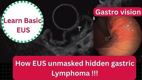 EUS Layers Explained Through a Real Case: From Dyspepsia to Lymphoma