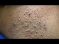 Deep Pore Cleansing Facial Routine for Acne & Blackheads - Satisfying ASMR