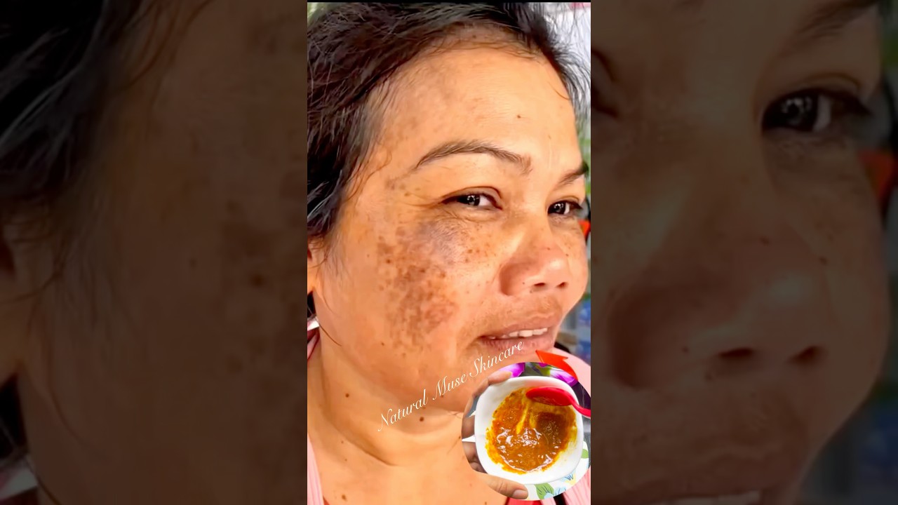 Clean Dark Spots & Pigmentation Naturally At Home | Get Glowing Skin Remove Tanning 