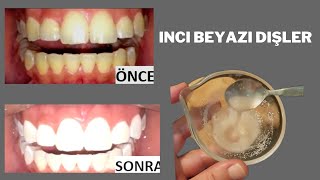 Babamın diş beyazlatma yöntemi ile ilk uygulamada inci beyazı dişler