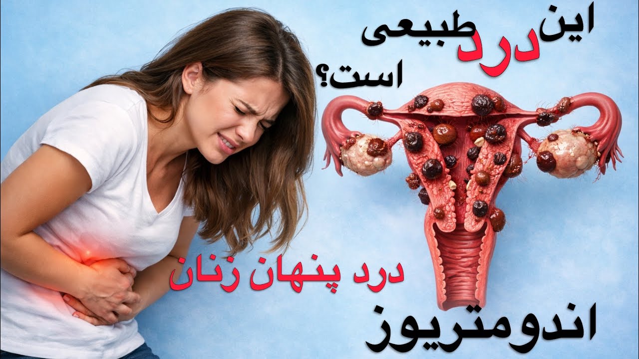 اندومتریوز چیست؟ | علت دردهای شدید پریود که نباید نادیده گرفت