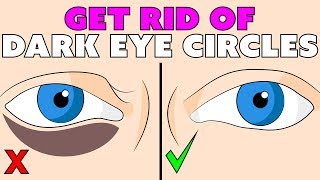 How to get rid of the dark circles under your eyes naturally - do it 2 times a day