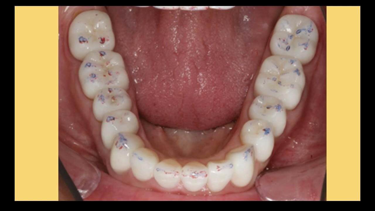 NECADE Sessions 32 Occlusal Equilibration YouTube