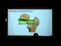 Case presentation of surgical hip preservation
