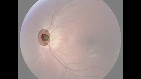 Retinal Optic disc and Cup Segmentation using Feature Matching Loss function through cGAN