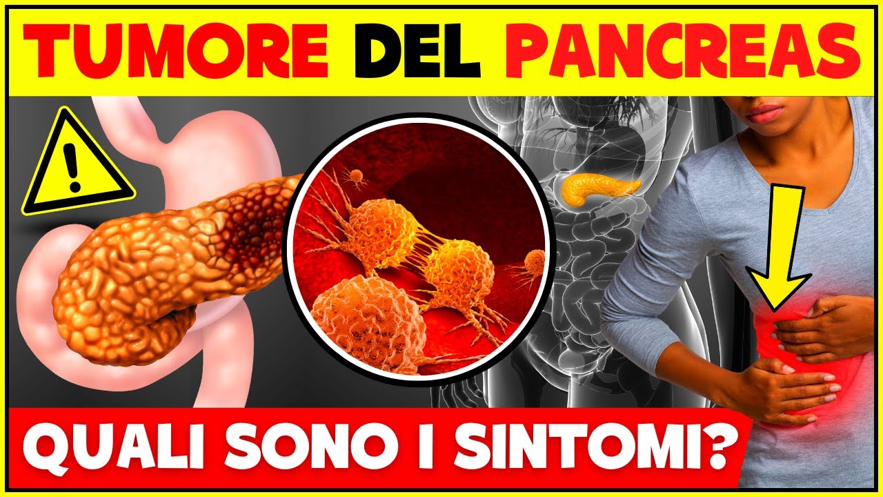 TUMORE DEL PANCREAS Quali Sono i Sintomi? Come Riconoscerlo? Segni Del Tumore Al Pancreas TUMORE DEL PANCREAS Quali Sono i Sintomi? Come Riconoscerlo? Segni Del Tumore Al Pancreas