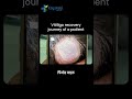 Scalp Vitiligo का 3 महीनों में इलाज कैसे हुआ? | Safed Daag Recovery | Kayakalp Global #shorts