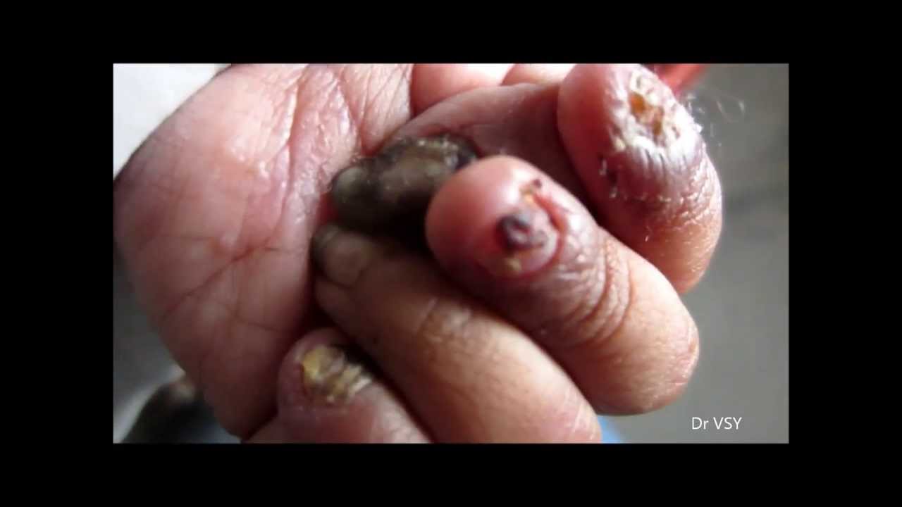 Q4U -Nail Diseases - YouTube