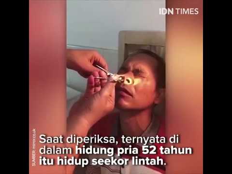 Video: Lintah Asia Tinggal Di Hidung Wanita Inggeris Selama Sebulan - - Pandangan Alternatif