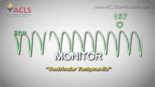 Ventricular Tachycardia by ACLS Certification Institute