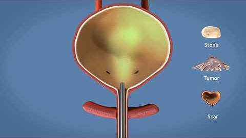 Cystoscopy (overactive bladder)