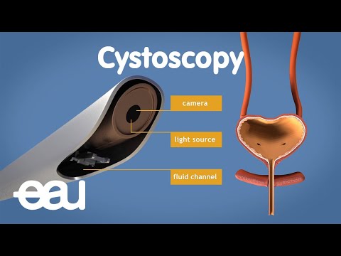 Video: Je, cystoscopy inaumiza?