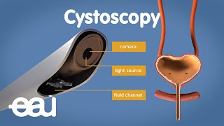 Cystoscopy (overactive bladder) screenshot 4