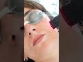 REDTOUCH PRO: innovación en regeneración facial
