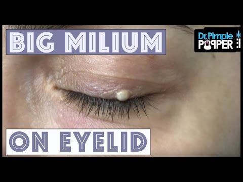 One Big Milium With Dr Pimple Popper