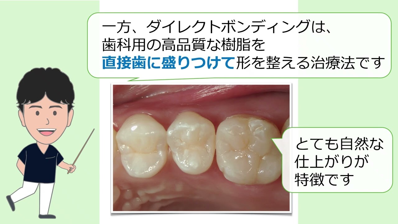 ダイレクトボンディング - 岡崎市の歯医者、織田歯科医院