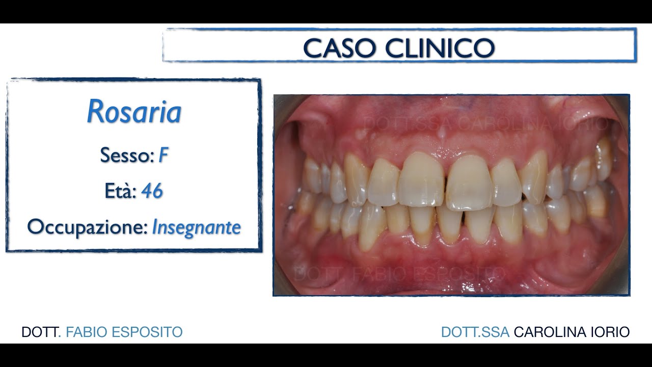 CASO CLINICO CASO CLINICO COMPLESSO DI PARODONTITE AVANZATA