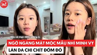 Ngỡ Ngàng Mặt Mộc Mẫu Nhí Minh Vy, Làn Da Chi Chít Đốm Đỏ Ai Nhìn Cũng Xót