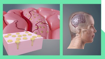 Empowering next-generation implantable brain interfaces | Timothy Constandinou