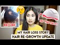 MY HAIR LOSS STORY (ALOPECIA AREATA)😢⎮iRestore LASER HAIR GROWTH SYSTEM 1-year UPDATE⎮BEFORE & AFTER