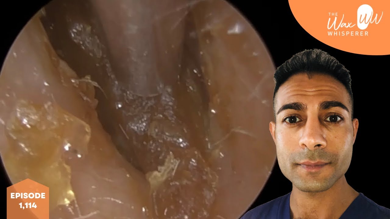 1,114 Crusted Blocked Ear Wax Removal YouTube