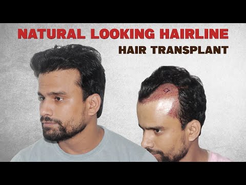 Hair Transplant Before After Videos | Hair Transplant Videos