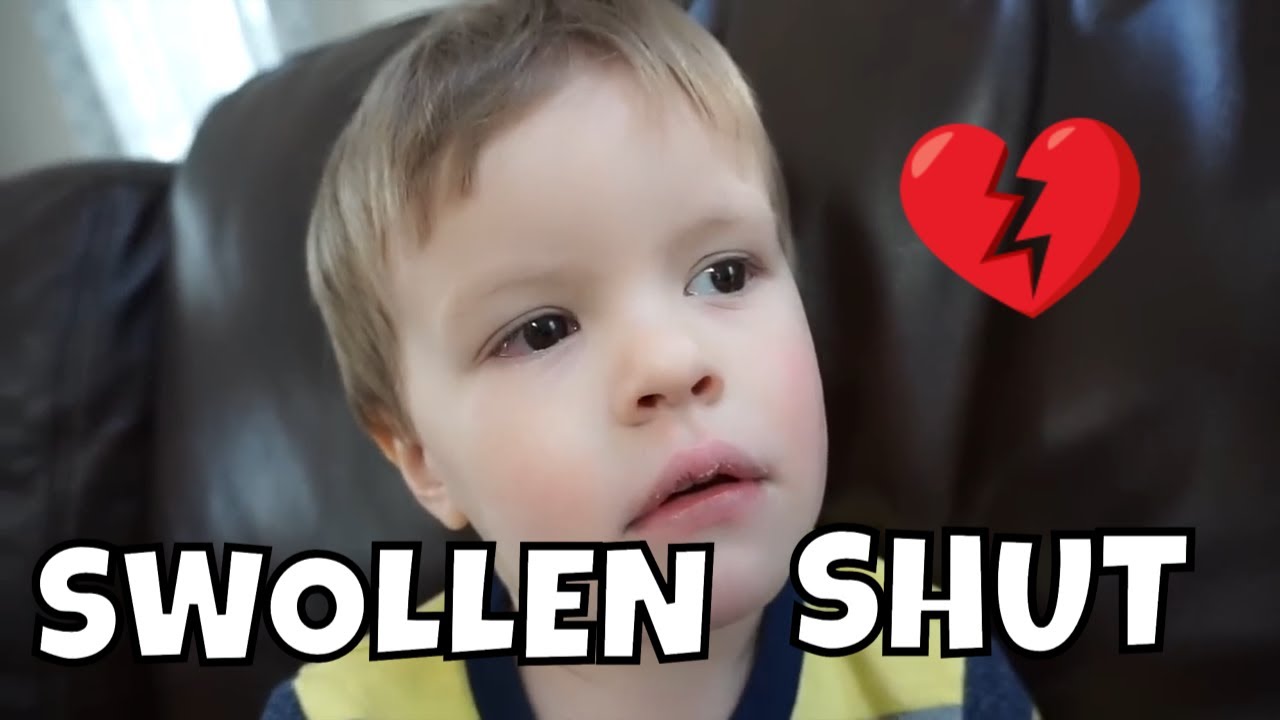 ANDREW IS SICK WITH PINK EYE!!??