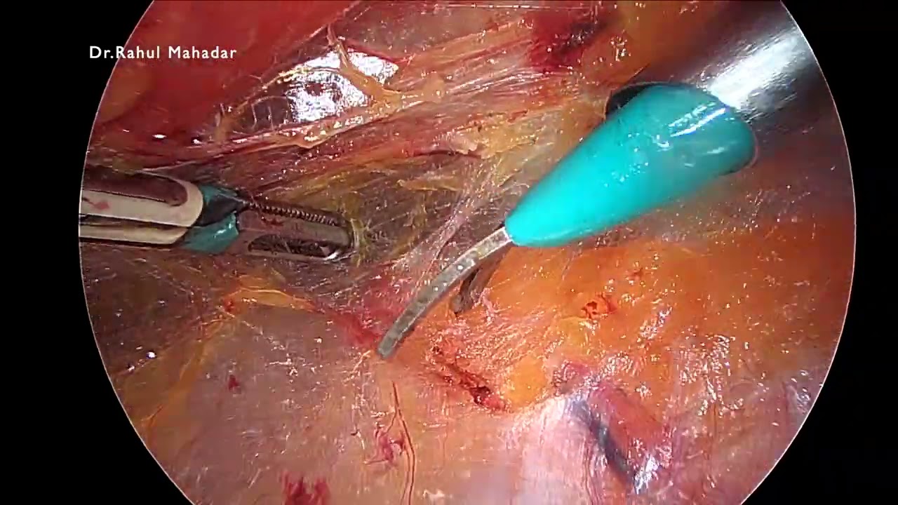 Como Dormir Apos Cirurgia De Hernia Inguinal