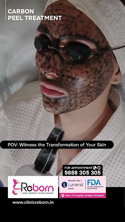 ✨ Reveal Radiant Skin with Carbon Peel Treatment! ✨