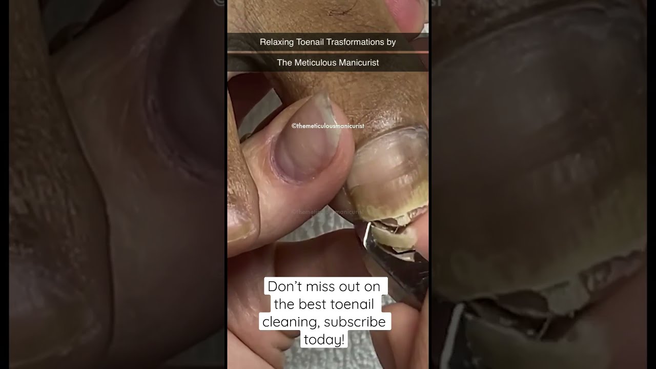 Best Toenail Cleaning
