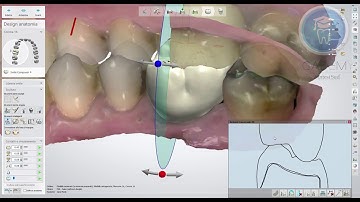 4 ways to adapt crown design to antagonist in 3Shape DentalSystem