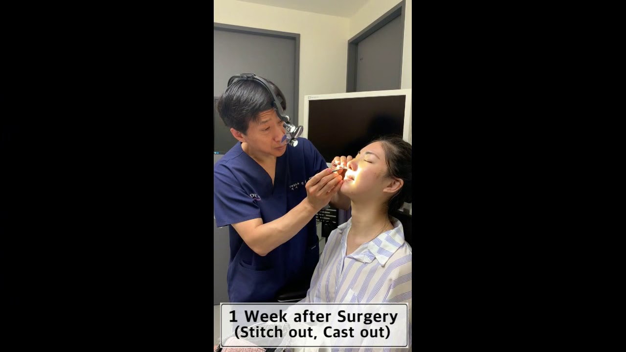 Miss A's revision rhinoplasty journey to Dr. Jin