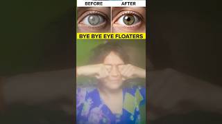 Good Bye Eye Floaters👁😱 #shorts