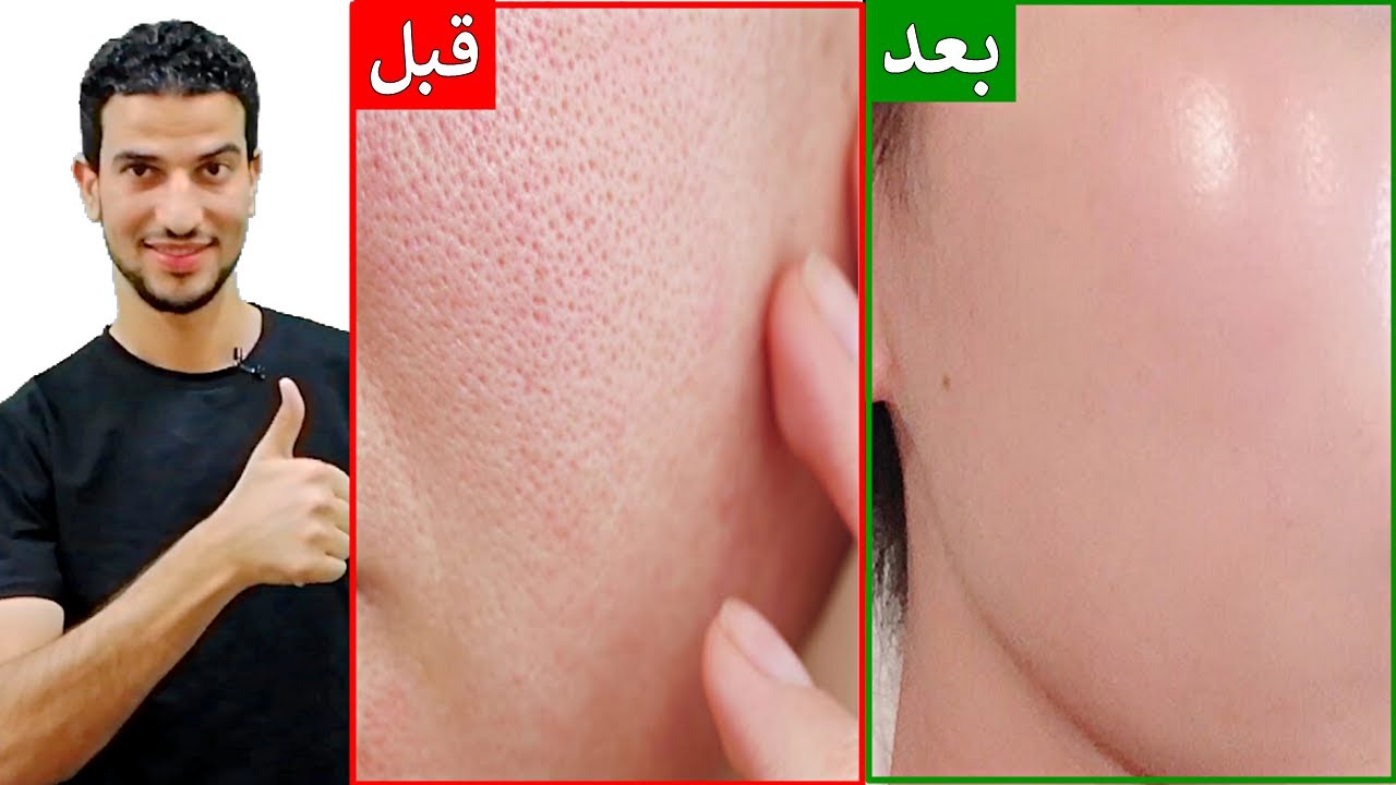 طريقة مذهلة لتضييق المسام الواسعة ونضارة البشرة في ايام
