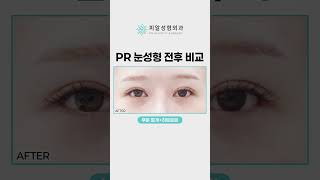[피알성형외과] 눈성형 전후 비교｜부분절개+하트트임