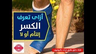 ازاى تعرف الكسر التأم او لا | علامات يعتمد عليها الطبيب فى تشخيص التئام الكسور