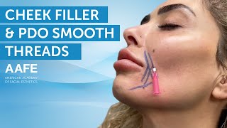 Cheek Filler and PDO Smooth Threads | AAFE