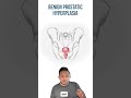 Benign Prostatic Hyperplasia for the USMLE | HyGuru