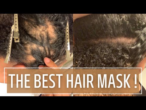 THE BEST Hair Mask for alopecia areata and promoting hair growth!!