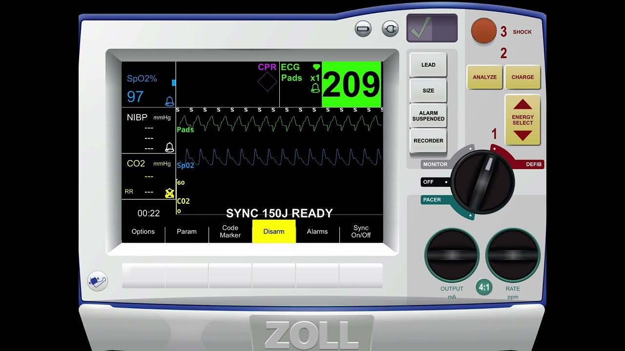 Zoll R series synchronised cardioversion of SVT with 3 shocks (120J