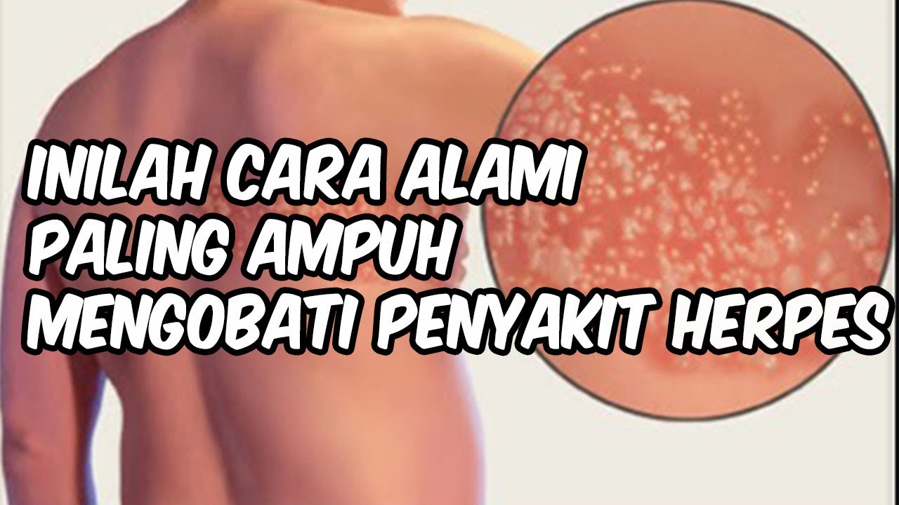 Herpes Dikulit Langsung Hilang Dengan Cepat || CARA MENGOBATI HERPES